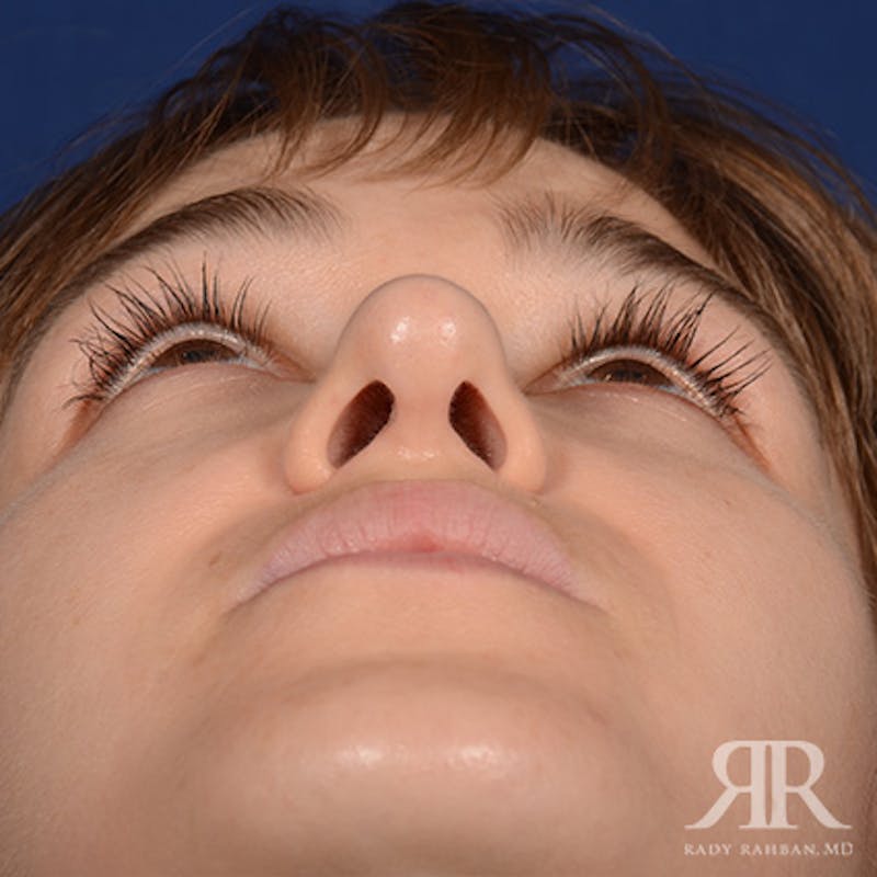 Female Rhinoplasty Before & After Gallery - Patient 161880 - Image 8