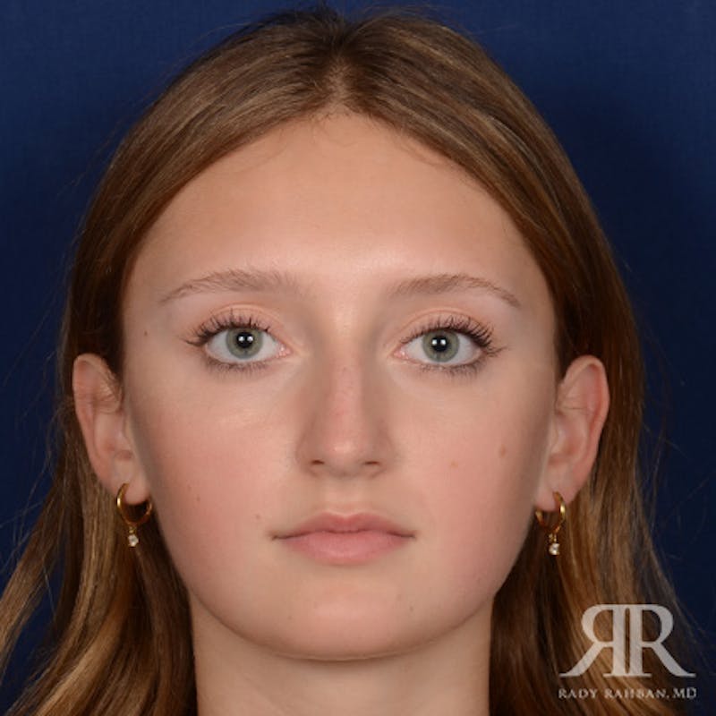 Female Rhinoplasty Before & After Gallery - Patient 193304 - Image 1