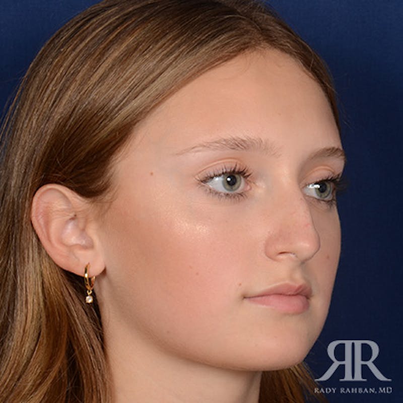 Female Rhinoplasty Before & After Gallery - Patient 193304 - Image 3
