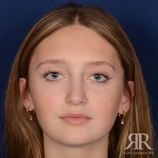 Female Rhinoplasty Before & After Gallery - Patient 193304 - Image 2