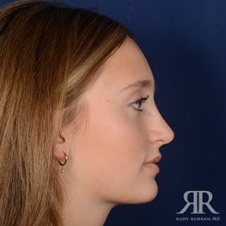 Female Rhinoplasty Before & After Gallery - Patient 193304 - Image 6