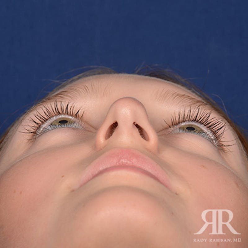 Female Rhinoplasty Before & After Gallery - Patient 193304 - Image 7