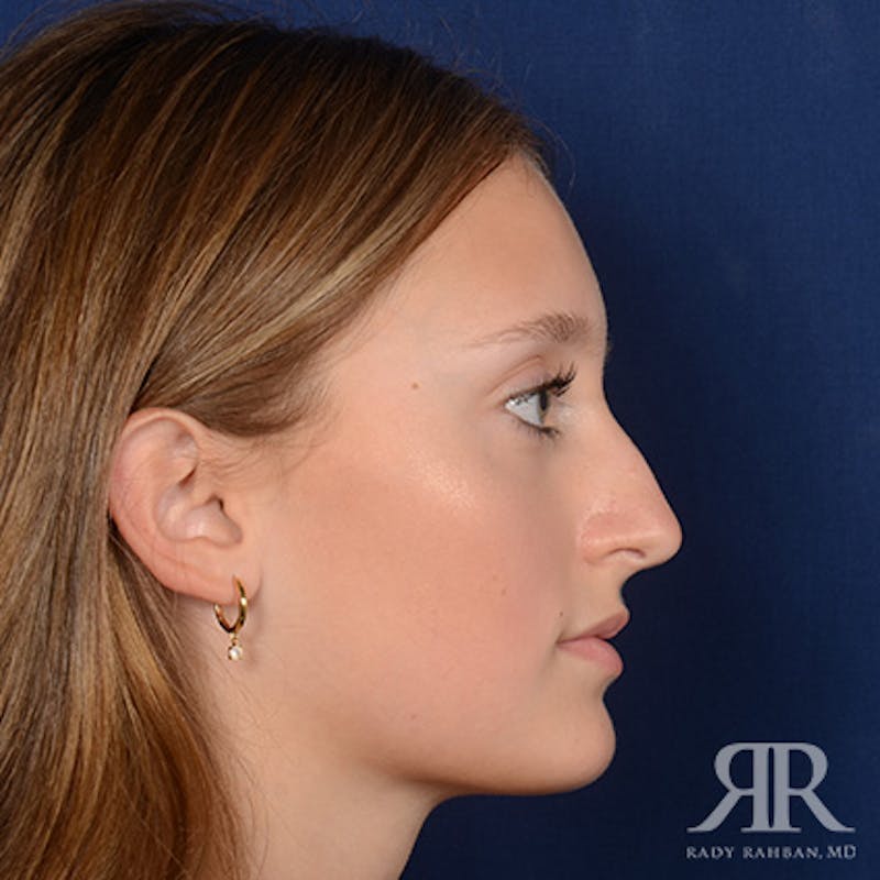 Female Rhinoplasty Before & After Gallery - Patient 193304 - Image 5