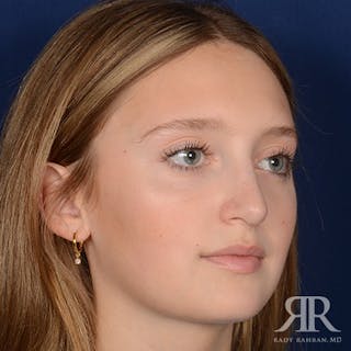 Female Rhinoplasty Before & After Gallery - Patient 193304 - Image 4