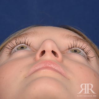 Female Rhinoplasty Before & After Gallery - Patient 193304 - Image 8