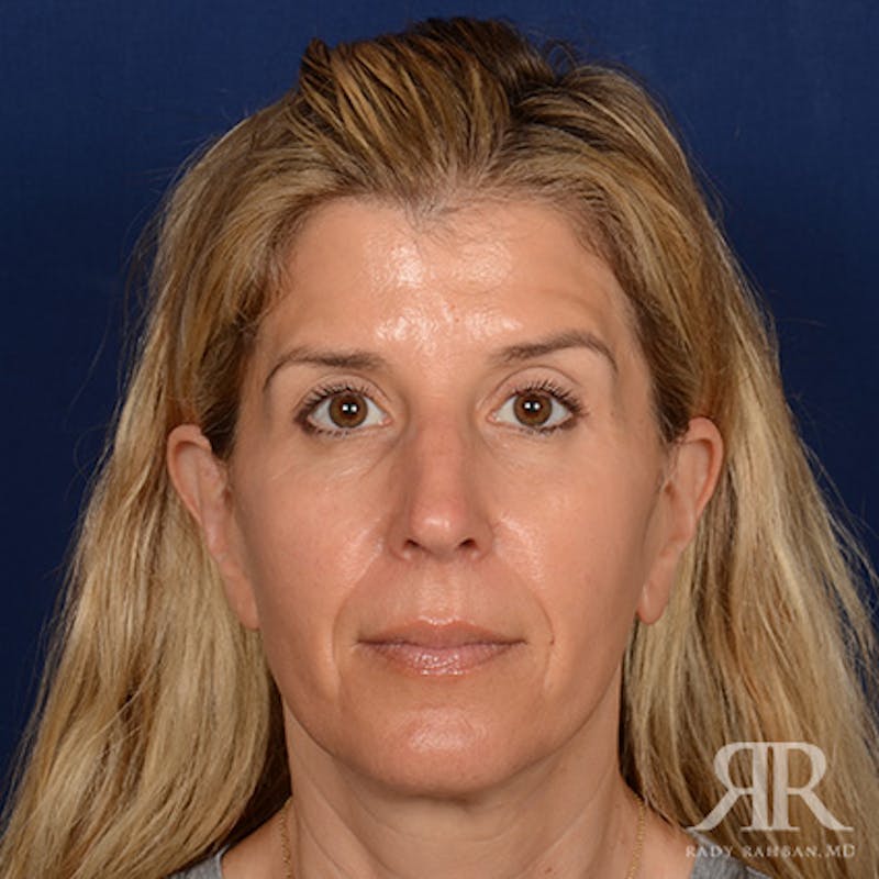 Female Rhinoplasty Before & After Gallery - Patient 224291 - Image 1