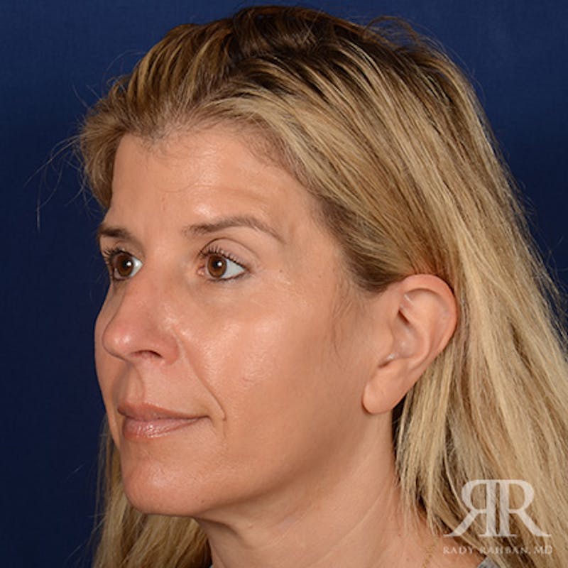 Female Rhinoplasty Before & After Gallery - Patient 224291 - Image 3