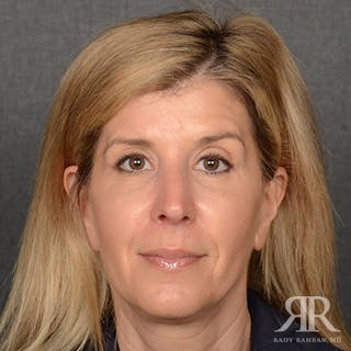 Female Rhinoplasty Before & After Gallery - Patient 224291 - Image 2