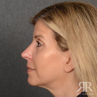 Female Rhinoplasty Before & After Gallery - Patient 224291 - Image 6