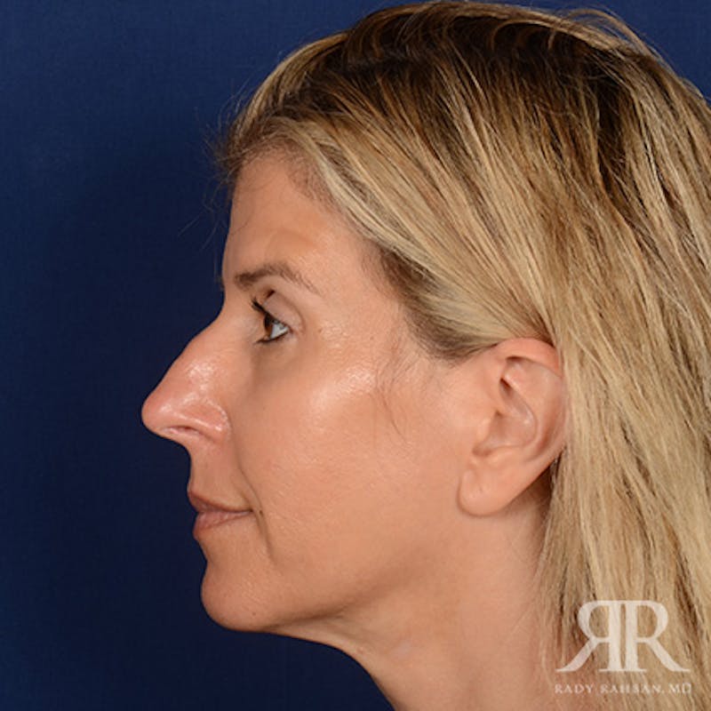 Female Rhinoplasty Before & After Gallery - Patient 224291 - Image 5