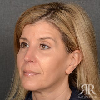 Female Rhinoplasty Before & After Gallery - Patient 224291 - Image 4