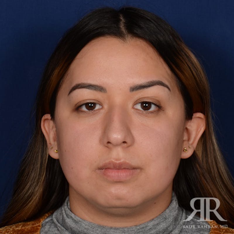 Female Rhinoplasty Before & After Gallery - Patient 415337 - Image 1