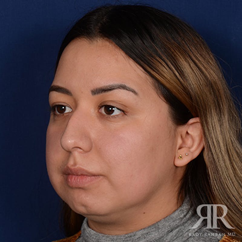 Female Rhinoplasty Before & After Gallery - Patient 415337 - Image 3