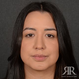 Female Rhinoplasty Before & After Gallery - Patient 415337 - Image 2