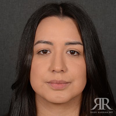 Female Rhinoplasty Before & After Gallery - Patient 415337 - Image 2