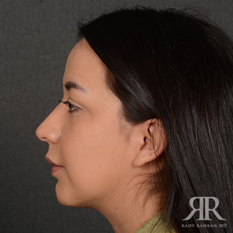Female Rhinoplasty Before & After Gallery - Patient 415337 - Image 6