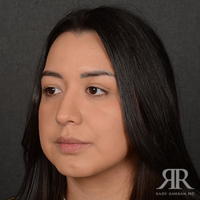 Female Rhinoplasty Before & After Gallery - Patient 415337 - Image 4