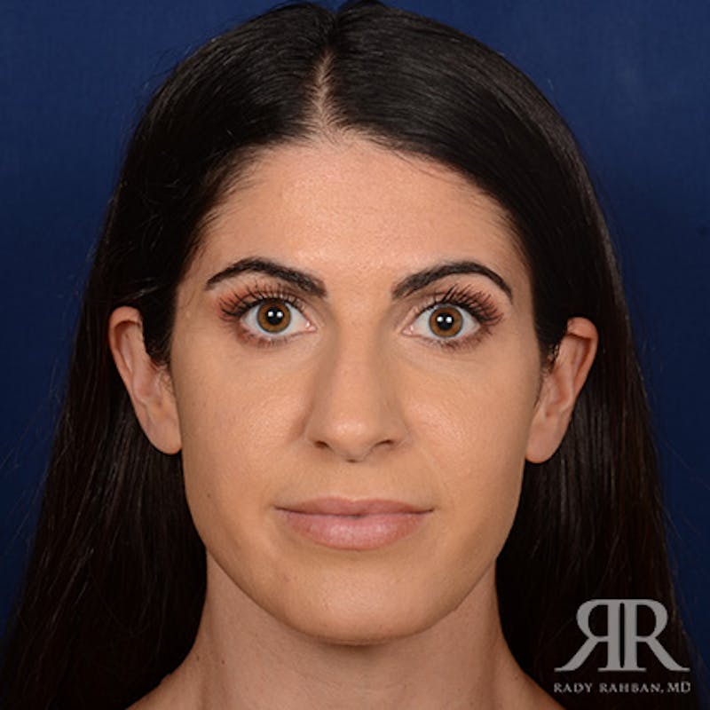 Female Rhinoplasty Before & After Gallery - Patient 405460 - Image 1
