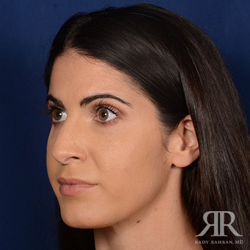 Female Rhinoplasty Before & After Gallery - Patient 405460 - Image 3