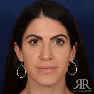 Female Rhinoplasty Before & After Gallery - Patient 405460 - Image 2