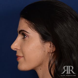 Female Rhinoplasty Before & After Gallery - Patient 405460 - Image 6