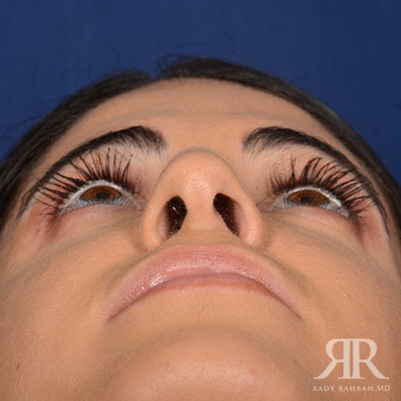 Female Rhinoplasty Before & After Gallery - Patient 405460 - Image 7