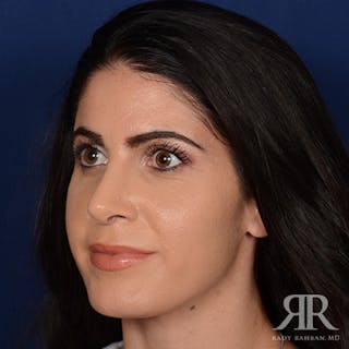 Female Rhinoplasty Before & After Gallery - Patient 405460 - Image 4