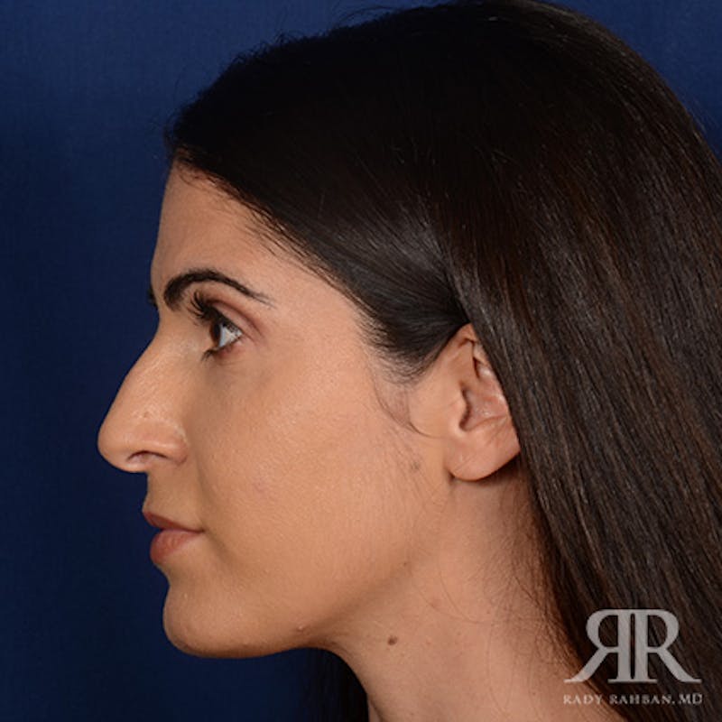 Female Rhinoplasty Before & After Gallery - Patient 405460 - Image 5