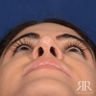 Female Rhinoplasty Before & After Gallery - Patient 405460 - Image 8