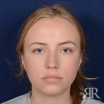 Female Rhinoplasty Before & After Gallery - Patient 275785 - Image 1