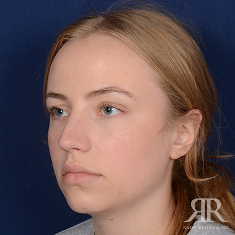 Female Rhinoplasty Before & After Gallery - Patient 275785 - Image 3