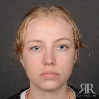 Female Rhinoplasty Before & After Gallery - Patient 275785 - Image 2