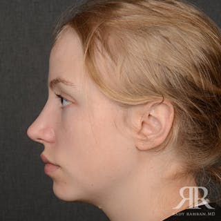 Female Rhinoplasty Before & After Gallery - Patient 275785 - Image 6