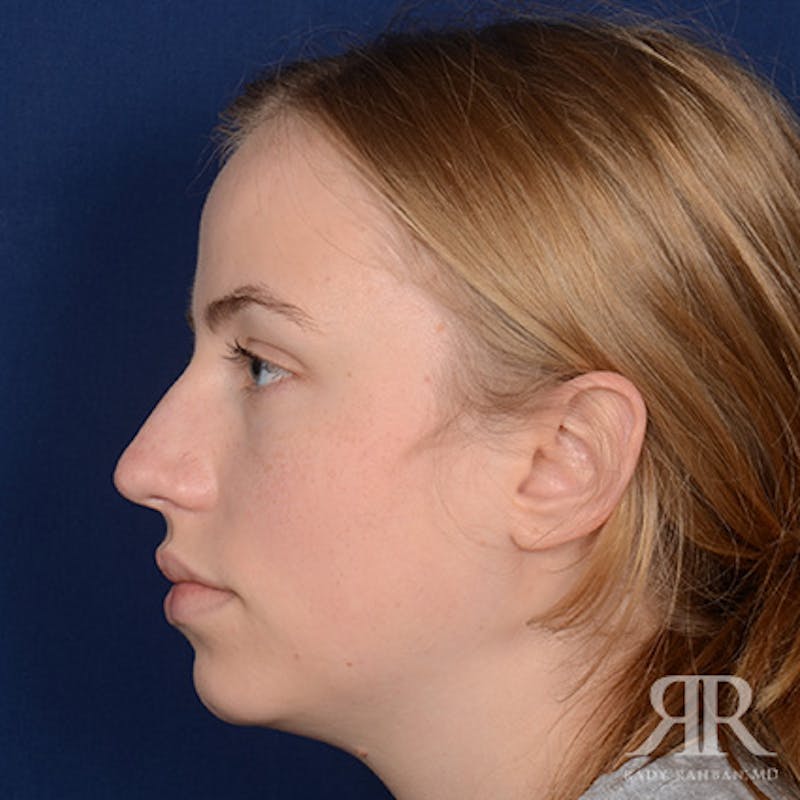 Female Rhinoplasty Before & After Gallery - Patient 275785 - Image 5