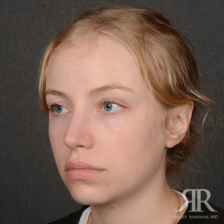 Female Rhinoplasty Before & After Gallery - Patient 275785 - Image 4