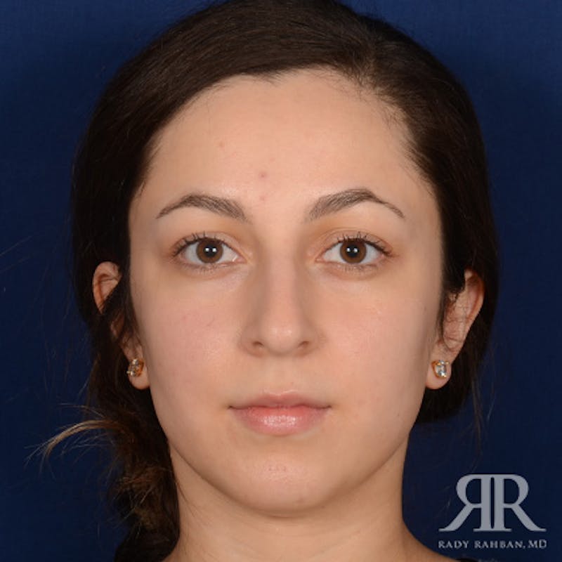 Female Rhinoplasty Before & After Gallery - Patient 299677 - Image 1