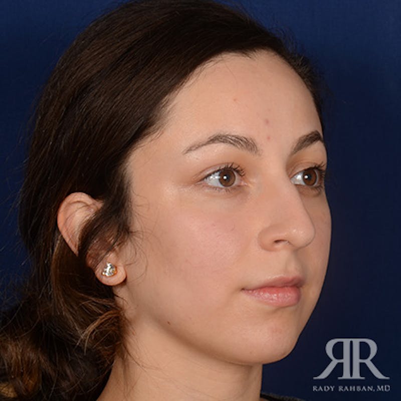 Female Rhinoplasty Before & After Gallery - Patient 299677 - Image 3