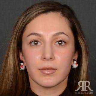 Female Rhinoplasty Before & After Gallery - Patient 299677 - Image 2
