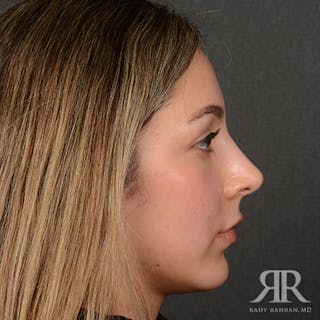 Female Rhinoplasty Before & After Gallery - Patient 299677 - Image 6