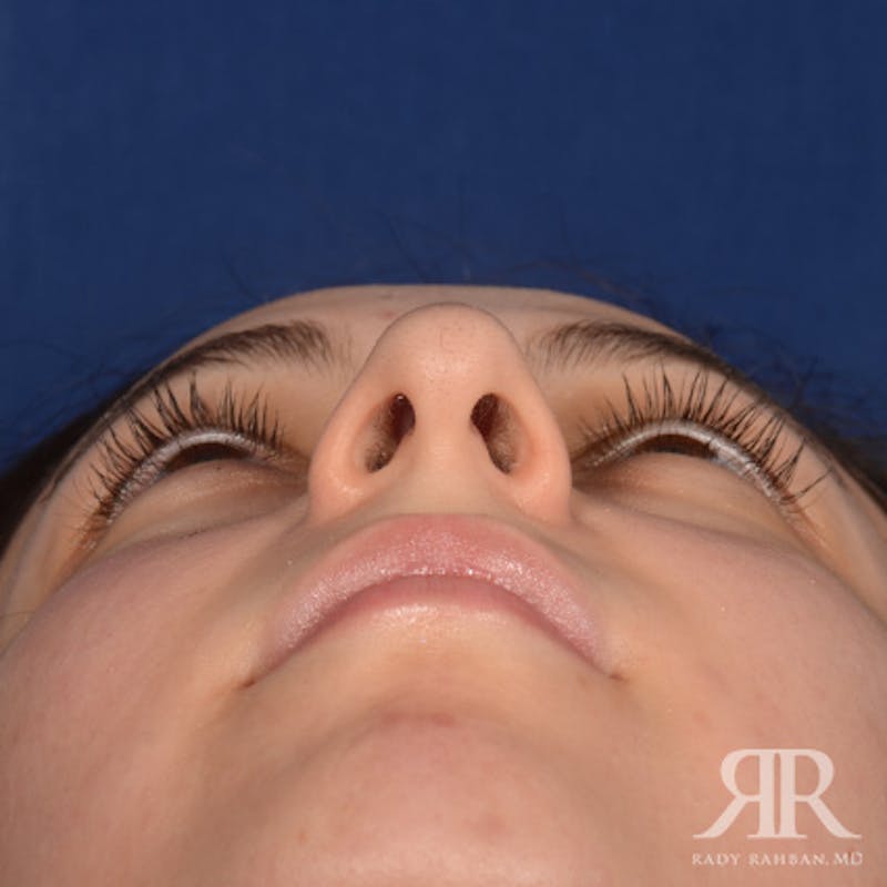 Female Rhinoplasty Before & After Gallery - Patient 299677 - Image 7