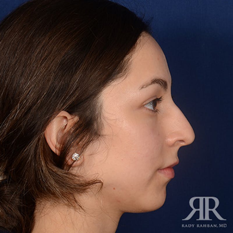 Female Rhinoplasty Before & After Gallery - Patient 299677 - Image 5