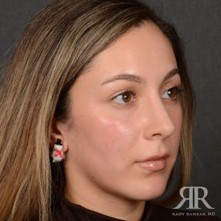 Female Rhinoplasty Before & After Gallery - Patient 299677 - Image 4