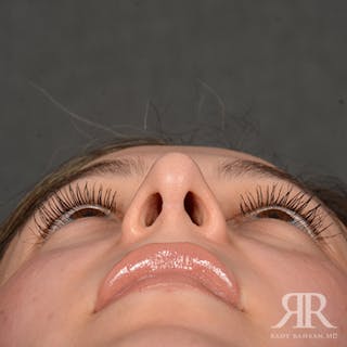 Female Rhinoplasty Before & After Gallery - Patient 299677 - Image 8