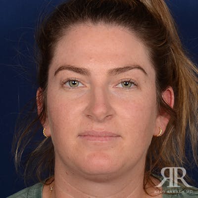 Female Rhinoplasty Before & After Gallery - Patient 230635 - Image 1