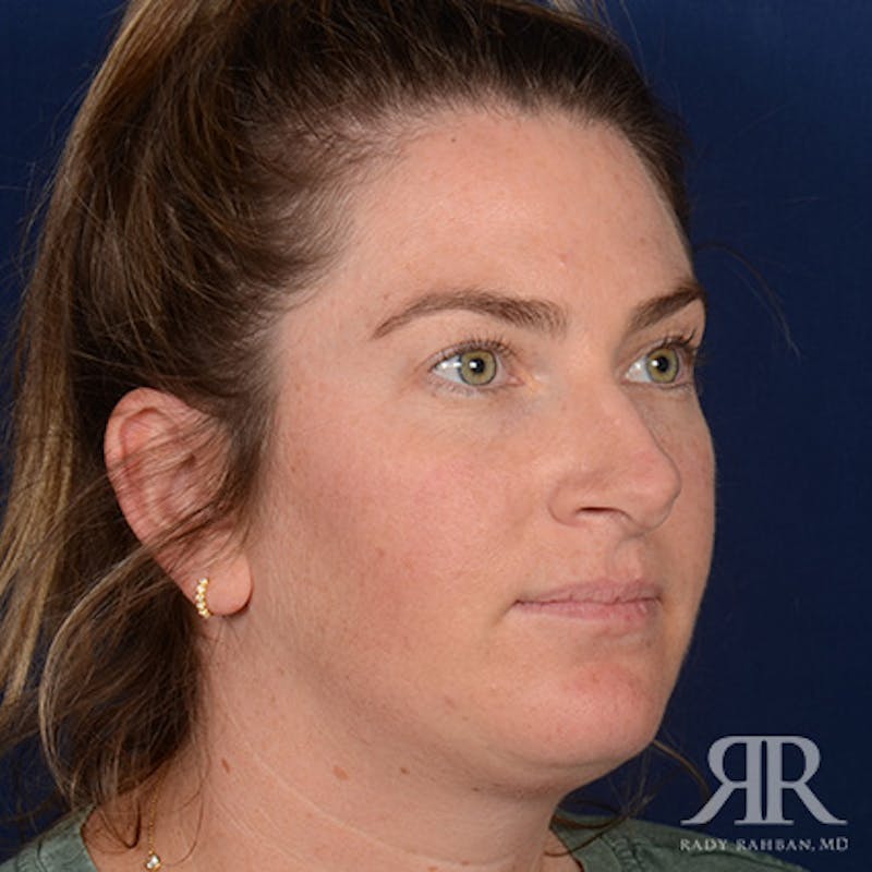 Female Rhinoplasty Before & After Gallery - Patient 230635 - Image 3