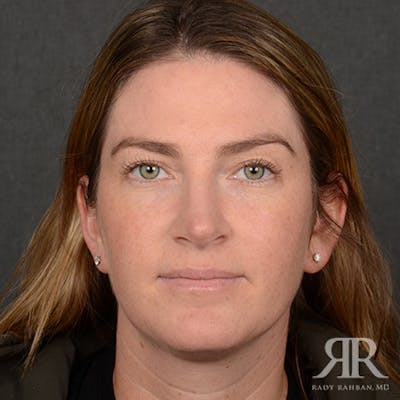Female Rhinoplasty Before & After Gallery - Patient 230635 - Image 2