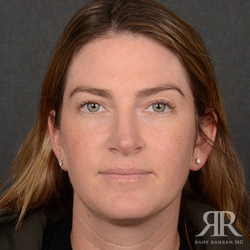 Female Rhinoplasty Before & After Gallery - Patient 230635 - Image 2
