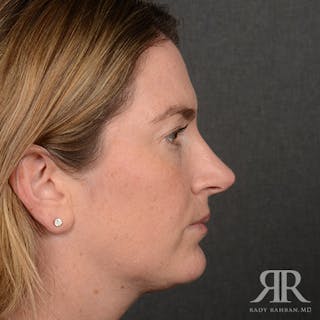 Female Rhinoplasty Before & After Gallery - Patient 230635 - Image 6