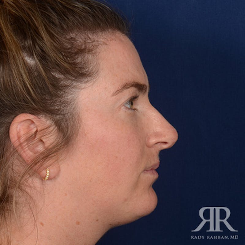 Female Rhinoplasty Before & After Gallery - Patient 230635 - Image 5