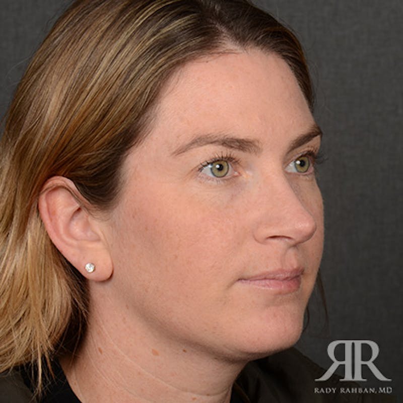 Female Rhinoplasty Before & After Gallery - Patient 230635 - Image 4